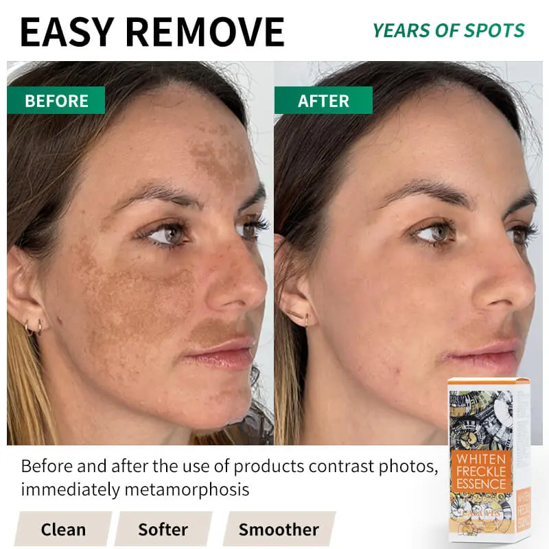 Freckles Removal serum Dark Spot Remover for Face Melasma Removal Depigmenting Melanin Correcting Facial Serum