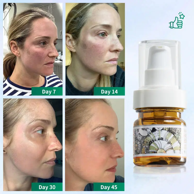 Freckles Removal serum Dark Spot Remover for Face Melasma Removal Depigmenting Melanin Correcting Facial Serum