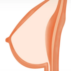 Solid Breast