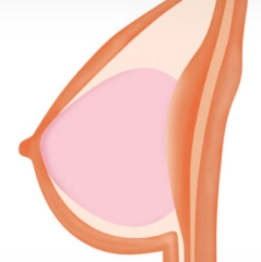 Gel Breast