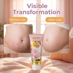 Before and after visual comparison demonstrating skin tissue renewal and fading results of Liru stretch mark remover cream on abdominal stretch lines.