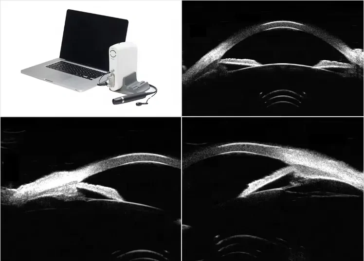 SW-3200S Full Scale UBM Ophthalmic UltrasoundEye Scanner(A/B/P/UBM)  AB Scan Pachymeter Biometer Portable UBM