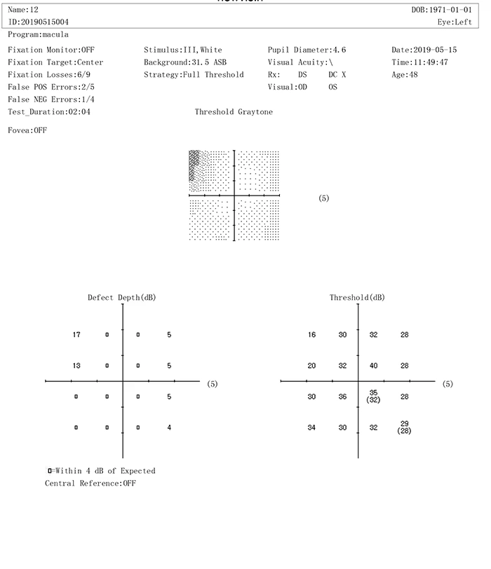 Cheapest New Style Projection Perimeter Fully Auto Perimeter BIO1000 Visual Field Analyzer
