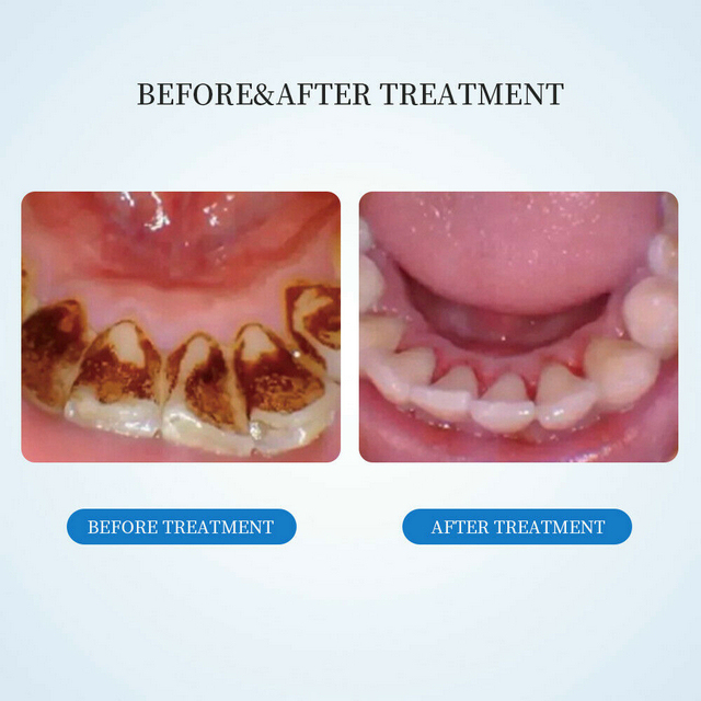 For Cavitron Dental Ultrasonic Scaler SKYSEA fit EMS Handpiece Tip+2 Bottles FDA