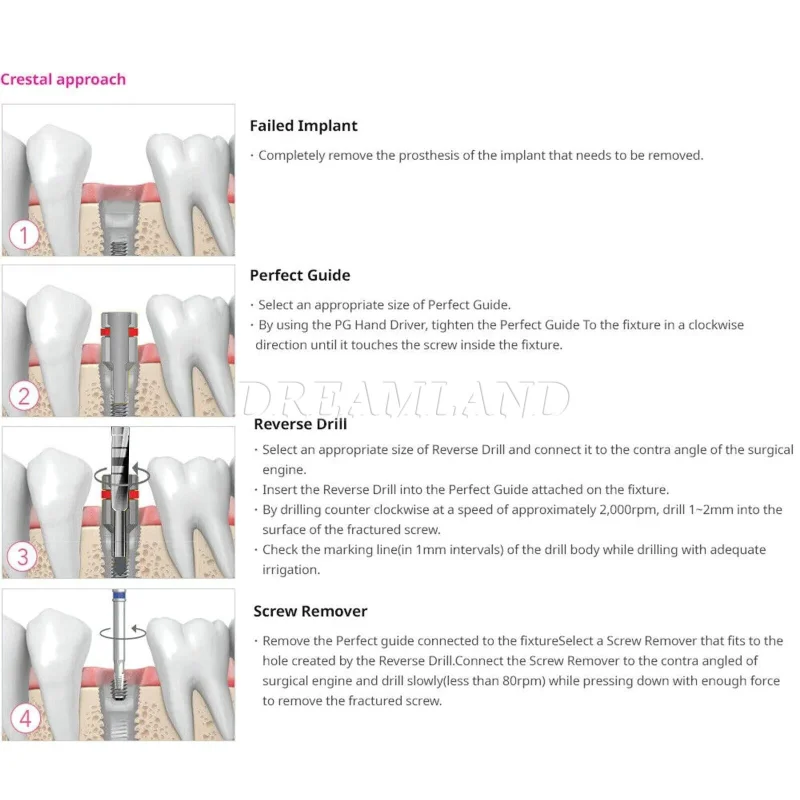 Dental Implant Broken Screw Remover Kit Reverse Drill Guide Driver