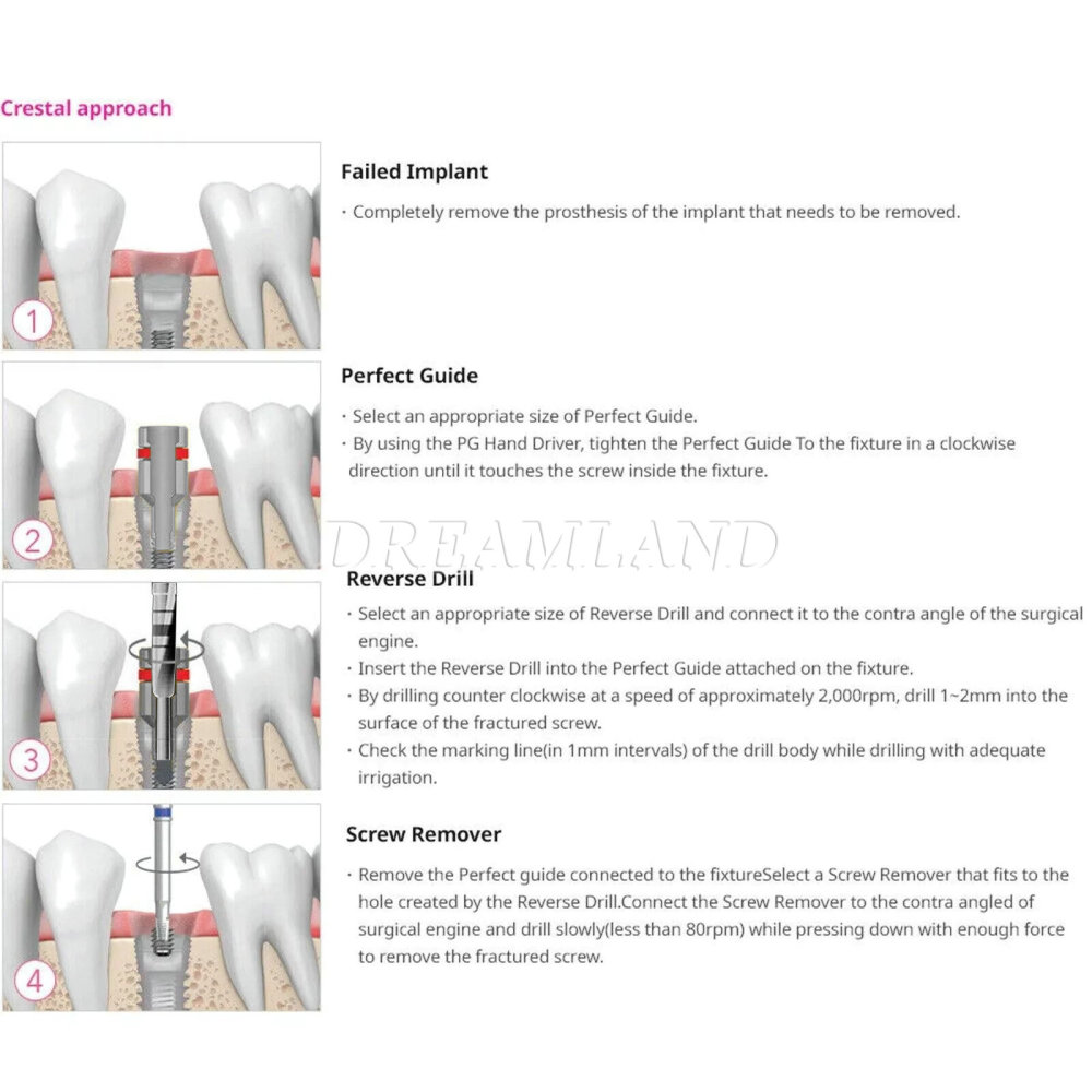 Dental Implant Broken Screw Remover Kit Reverse Drill Guide Driver