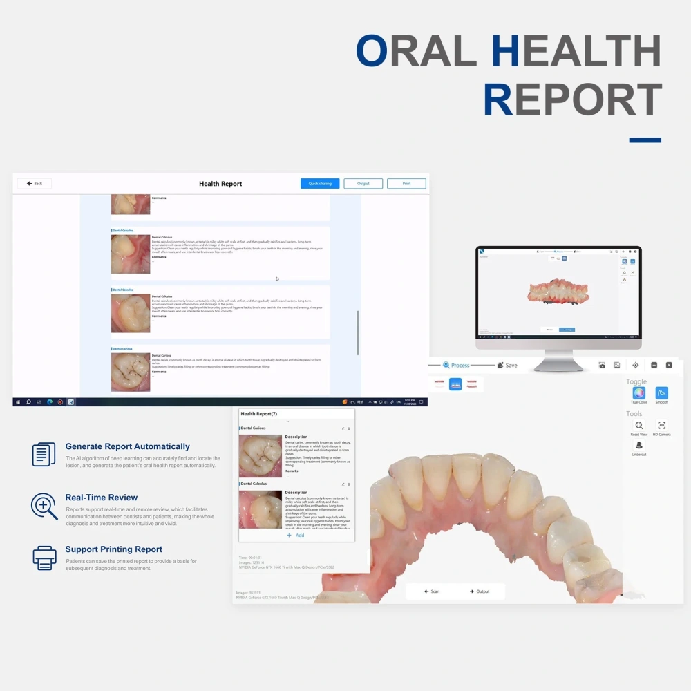 Dental Digital Impression Intra-Oral 3D Scanner