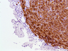 Anaplastic Lymphoma Kinase（ALK）