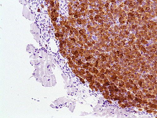 Anaplastic Lymphoma Kinase（ALK）