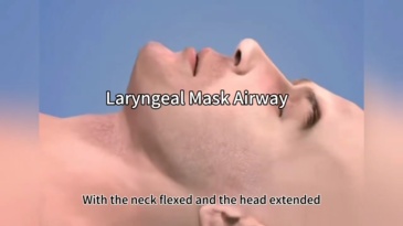 Disposable Silicone Laryngeal Airway
