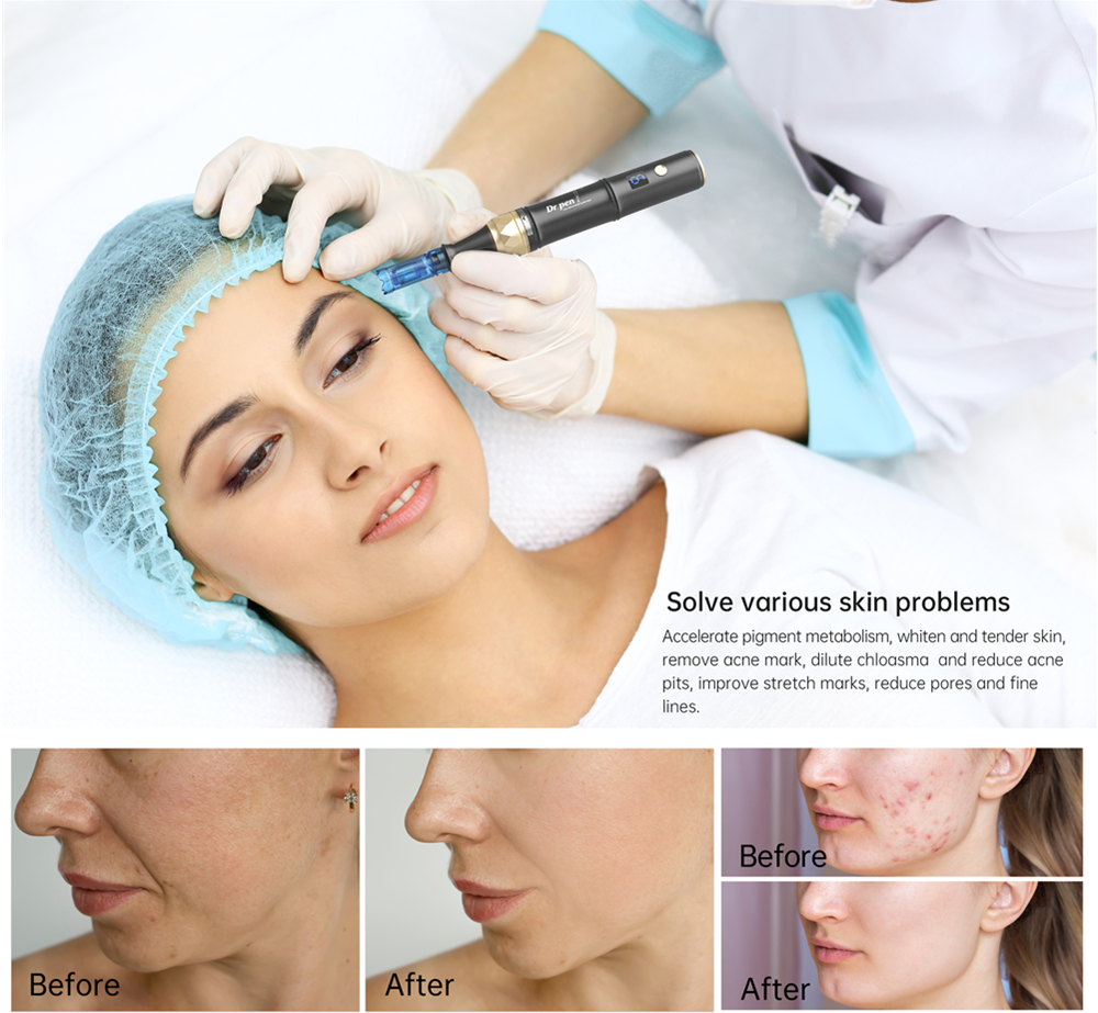 Dr.pen A8S Wireless Microneedle Therapy System Derma Pen