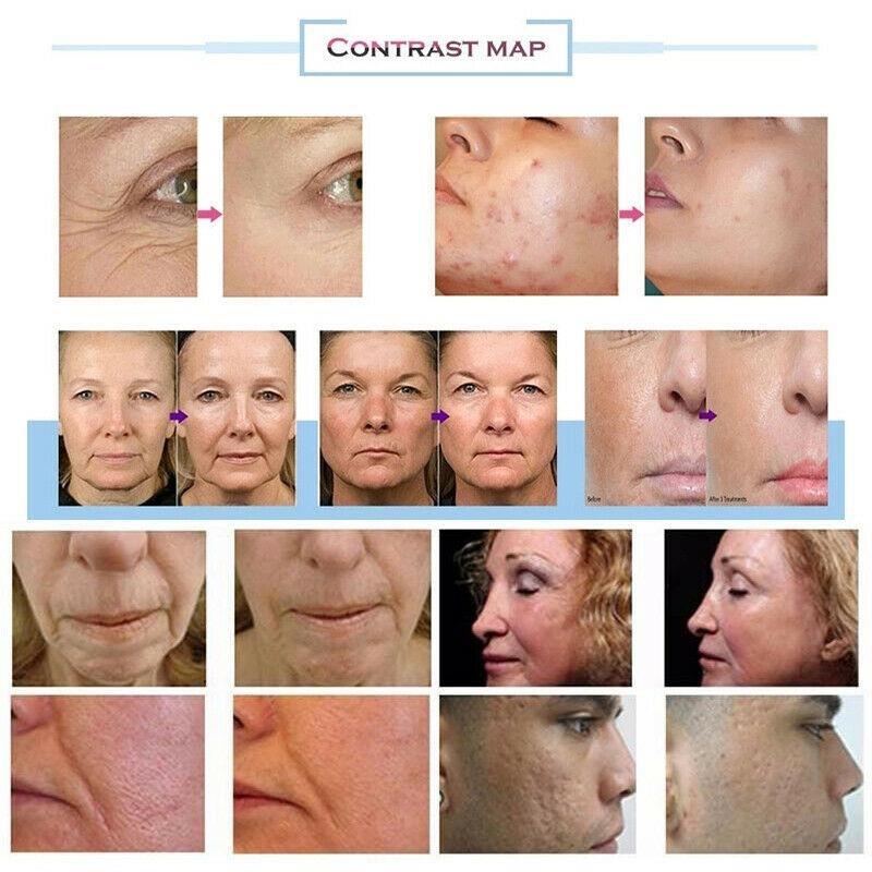 Morpheus 8 Portable Co2 Fractional Microneedling Stretch Marks Removal Beauty Machine