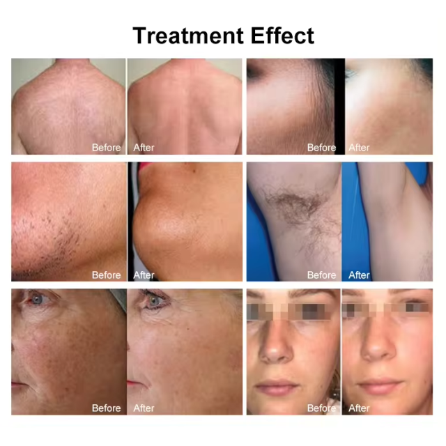 4 Waves 790 808 1060 940nm Painless 500- 2000W Bikini Hair Removal Diode Laser Diodo Depila Ice Laser Price
