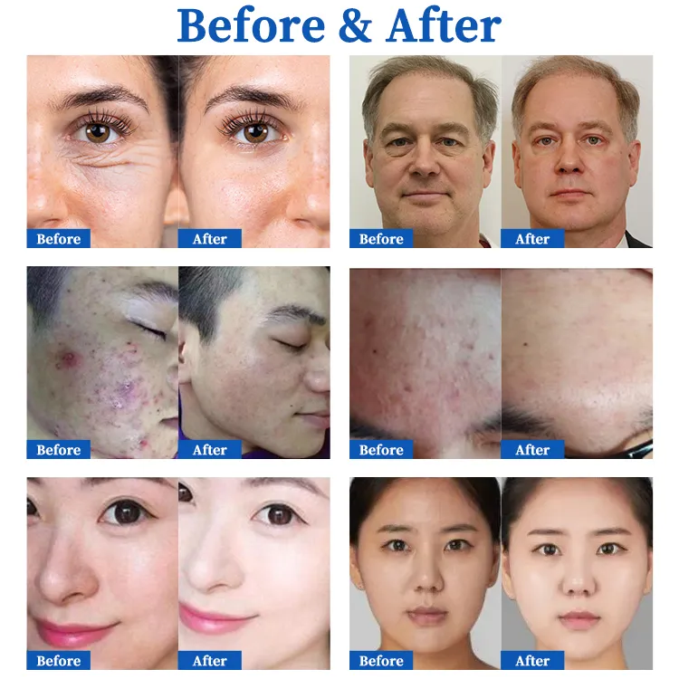 Plasma Acne Treatment Facial Skin Rejuvenation Deep Pore Cleaning Rf Ems Plasma Pen