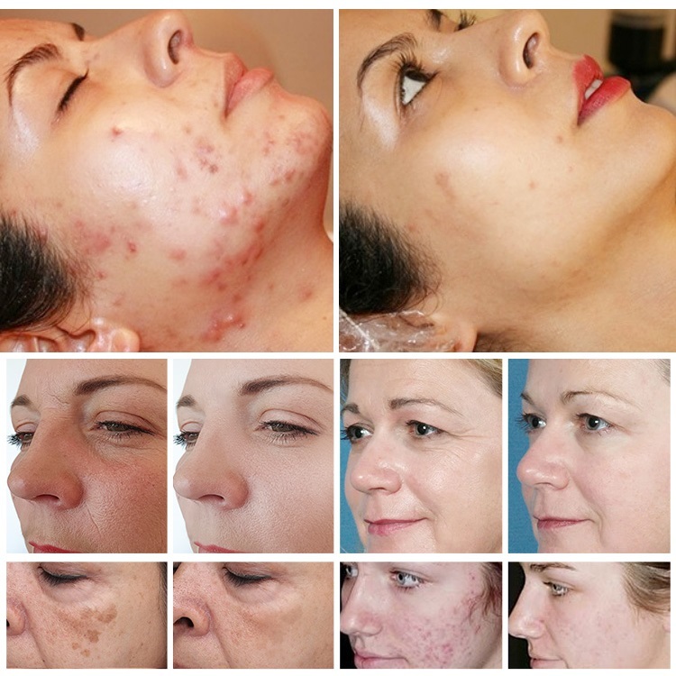 Professional 1927nm Thulium Laser Scare Remove Skin Tightening Portable Fractional Laser