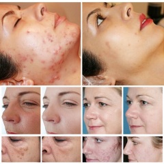 Professional 1927nm Thulium Laser Scare Remove Skin Tightening Portable Fractional Laser