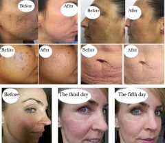 2 Handle Tixel Excellent Thermal Fractional Scar Acne Stretch Marks Removing