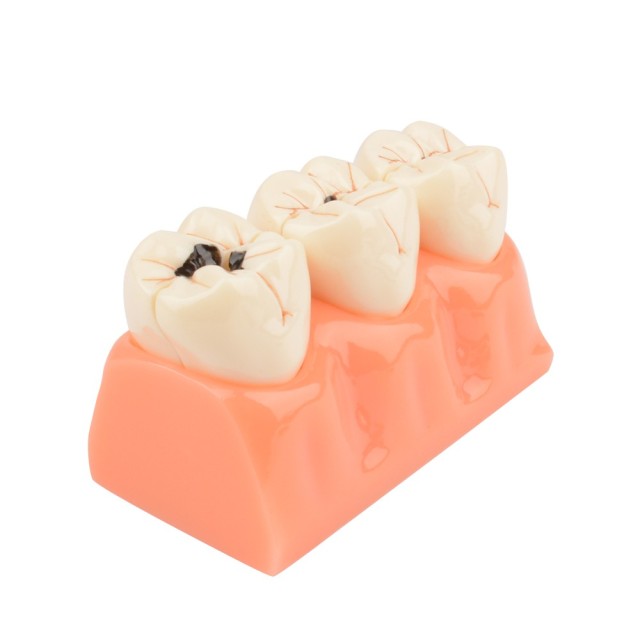 Tooth Decay Evolution Model - 4 Times Dental Caries for Teaching