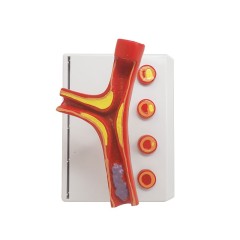Arteriosclerosis Model, with Cross Section of Artery, 4 Part
