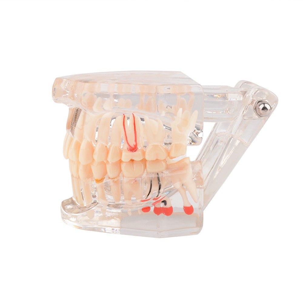Modèle D'étude Transparent Pour Implants Dentaires - Démonstration Pathologique Et Restauration, Outil De Formation