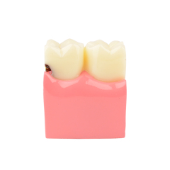 Dental Teeth Decay Model, 6 Times Caries, Comparative Study for Dentist
