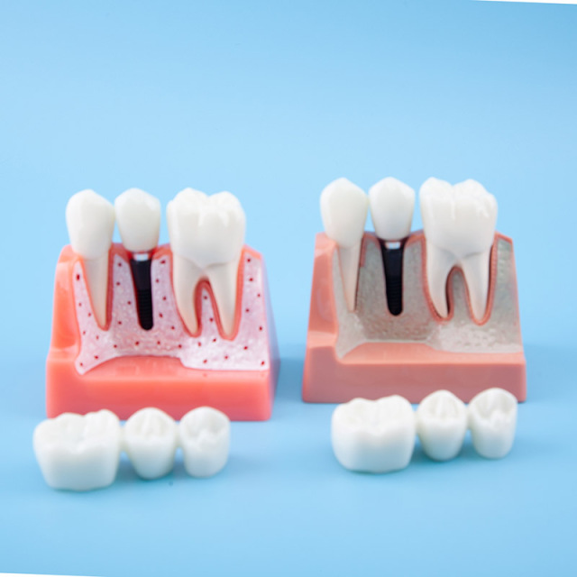 Removal Implant Teeth Model, 4 Times for Patient Education