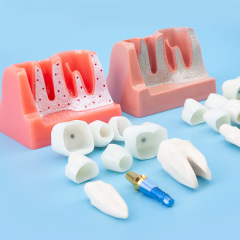 Removal Implant Teeth Model, 4 Times for Patient Education
