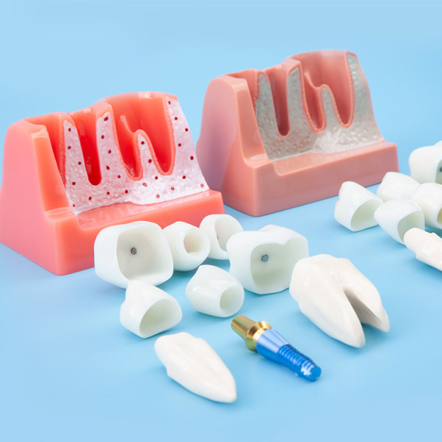 Removal Implant Teeth Model, 4 Times for Patient Education