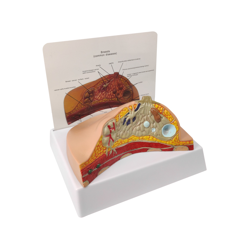Breast Cross-Section Anatomical Model with Common Pathologies