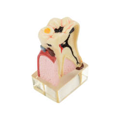 4 Times Tooth Caries Comprehensive Pathological Display Model with Nerve