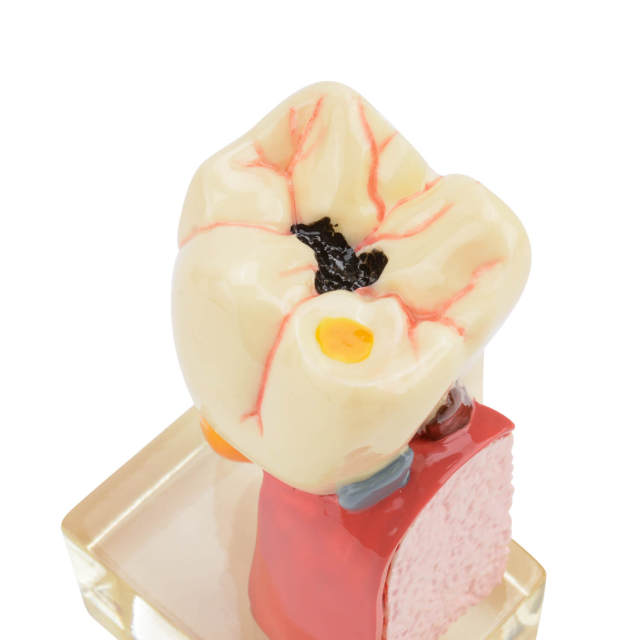 4 Times Tooth Caries Comprehensive Pathological Display Model with Nerve