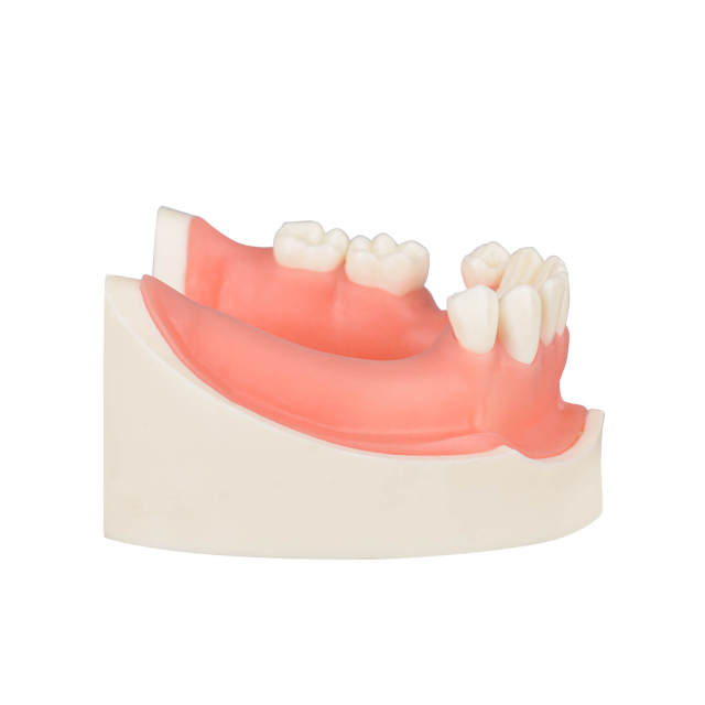 Human Mandible Implant Training Model Missing 47, 46, 45, 35 Teeth