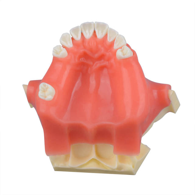 Implant Surgery Maxillary Sinus Lift Model for Training, Missing Teeth 15, 16, 25, 26, 27