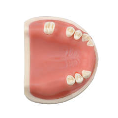 Maxillary Implant Surgery Practice Model, Missing 17, 12, 11, 21, 22, 26, 27 Teeth