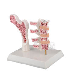 Menopausal Osteoporosis Model (OP Femur & 4 Vertebrae) for Medical Teaching