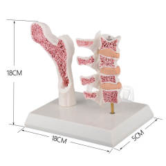 Menopausal Osteoporosis Model (OP Femur & 4 Vertebrae) for Medical Teaching
