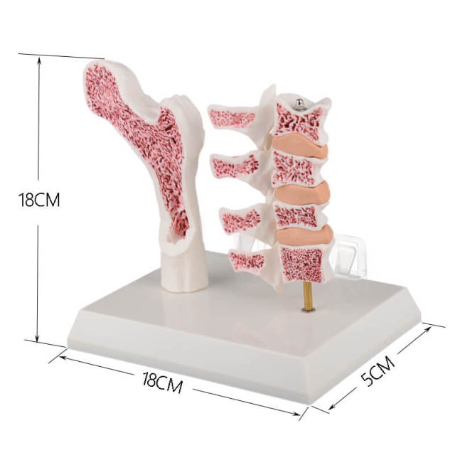 Menopausal Osteoporosis Model (OP Femur & 4 Vertebrae) for Medical Teaching