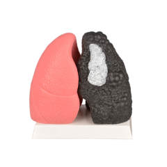 Healthy and Smokers Lung Model, Small and Large Size