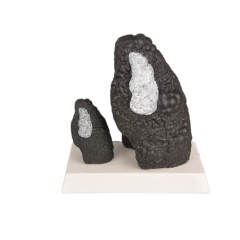 Healthy and Smokers Lung Model, Small and Large Size