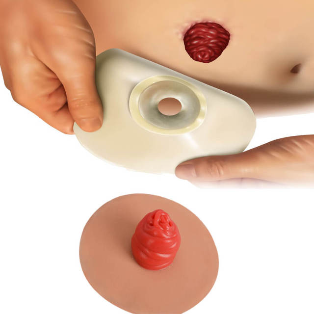 Sticky Ostomy Stoma Care Training Models Set