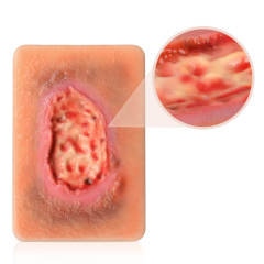 Pocket Necrotic Tissue Wound Card Model, 3 Types
