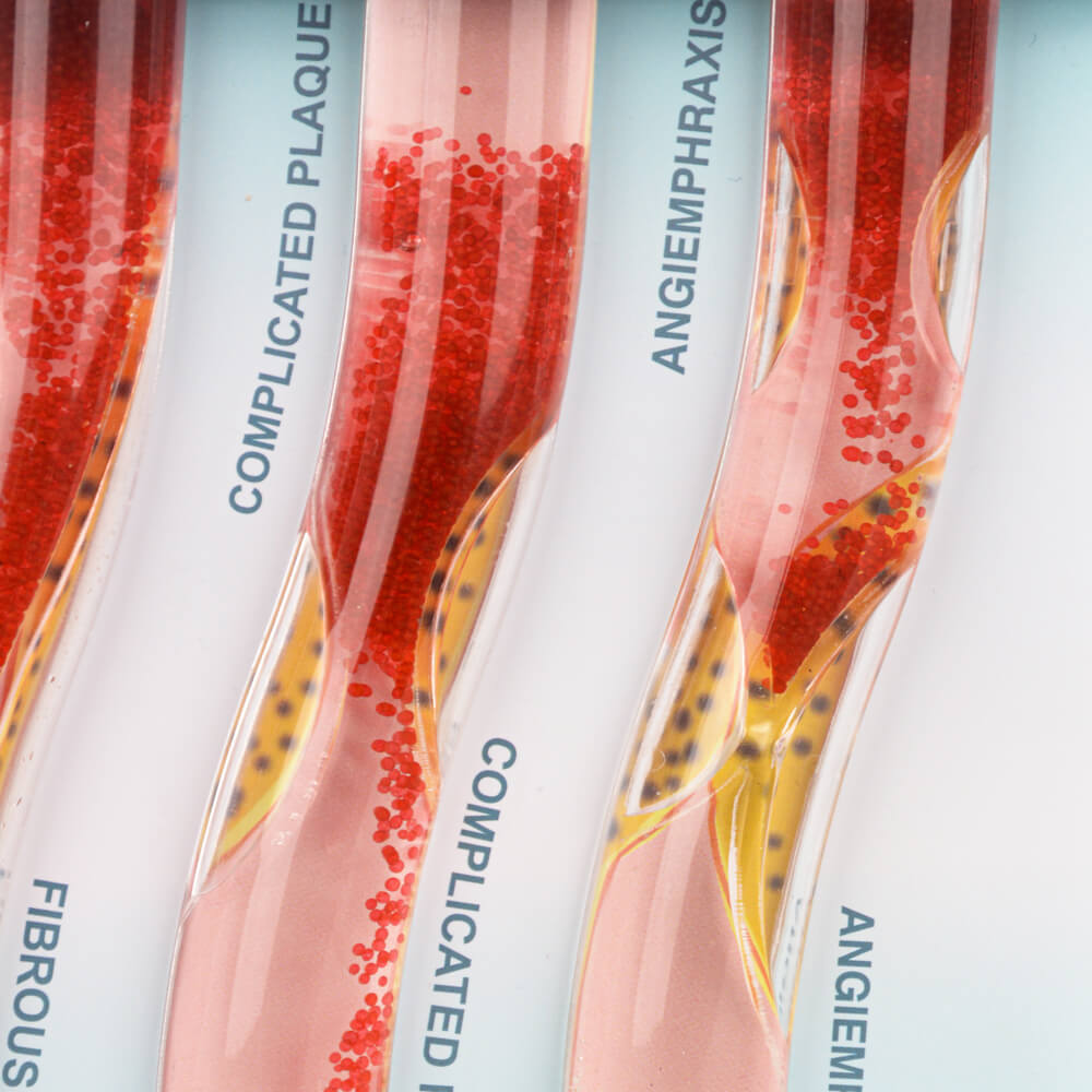 Four Stage Blood Vessel Blockage Model for Customization