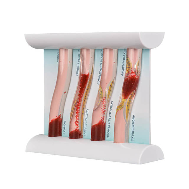 Four Stage Blood Vessel Blockage Model for Customization