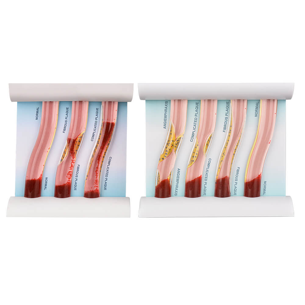 Four Stage Blood Vessel Blockage Model for Customization