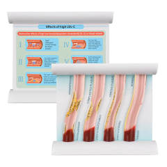 Four Stage Blood Vessel Blockage Model for Customization