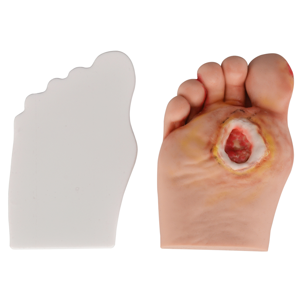 Science Medical Diabetic Foot Grading Pegboard Model, Diabetes Mellitus