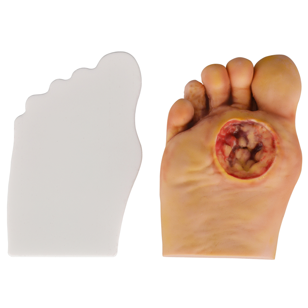 Science Medical Diabetic Foot Grading Pegboard Model, Diabetes Mellitus