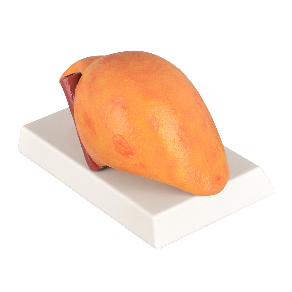 Human Pathological Liver Model with Alcoholic Liver Disease, Silicone