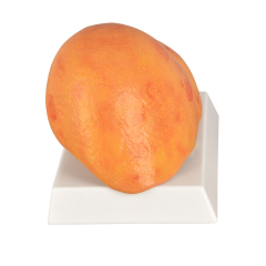 Human Pathological Liver Model with Alcoholic Liver Disease, Silicone