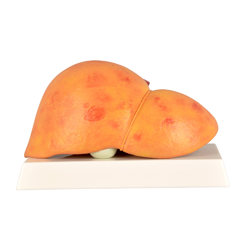 Human Pathological Liver Model with Alcoholic Liver Disease, Silicone